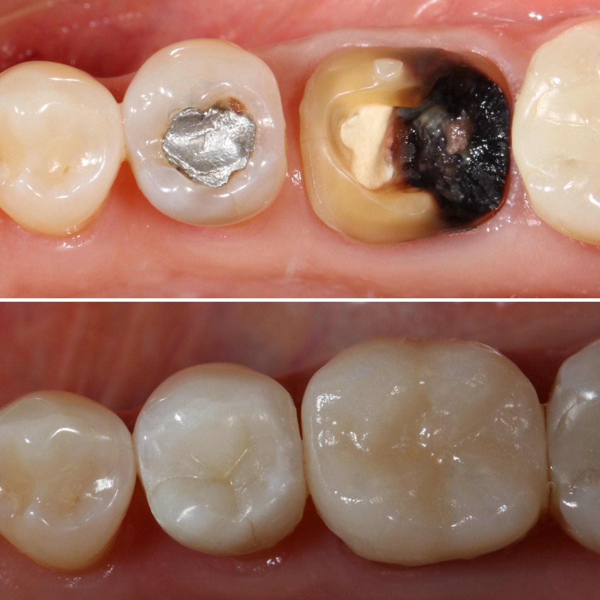 ankara diş hekimi, ankara diş kliniği, ankara estetik diş hekimliği, ankara implant, ankara implant tedavisi, ankara ortodonti, ankara şeffaf plak, ankara gülüş tasarımı, ankara zirkonyum kaplama, ankara diş beyazlatma, ankara kanal tedavisi, ankara diş eti tedavisi, ankara lamina, ankara porselen lamina, ankara diş protezi, ankara restoratif diş hekimliği, çankaya diş hekimi, çankaya diş kliniği, alacaatlı diş hekimi, yaşamkent diş hekimi, çayyolu diş hekimi