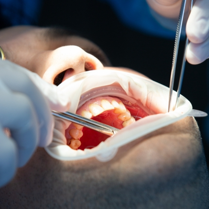 Ankara periodontoloji ve diş eti tedavisi