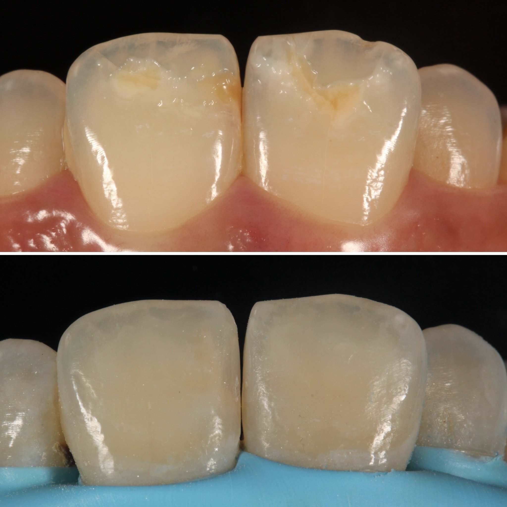 ankara diş hekimi, ankara diş kliniği, ankara estetik diş hekimliği, ankara implant, ankara implant tedavisi, ankara ortodonti, ankara şeffaf plak, ankara gülüş tasarımı, ankara zirkonyum kaplama, ankara diş beyazlatma, ankara kanal tedavisi, ankara diş eti tedavisi, ankara lamina, ankara porselen lamina, ankara diş protezi, ankara restoratif diş hekimliği, çankaya diş hekimi, çankaya diş kliniği, alacaatlı diş hekimi, yaşamkent diş hekimi, çayyolu diş hekimi