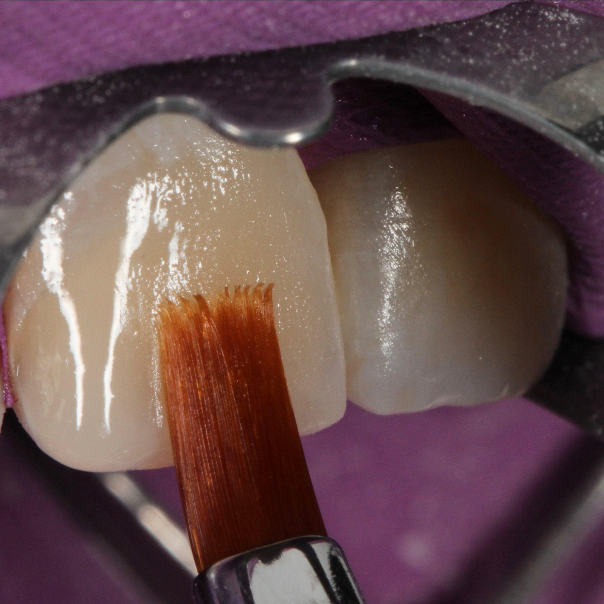 ankara diş hekimi, ankara diş kliniği, ankara estetik diş hekimliği, ankara implant, ankara implant tedavisi, ankara ortodonti, ankara şeffaf plak, ankara gülüş tasarımı, ankara zirkonyum kaplama, ankara diş beyazlatma, ankara kanal tedavisi, ankara diş eti tedavisi, ankara lamina, ankara porselen lamina, ankara diş protezi, ankara restoratif diş hekimliği, çankaya diş hekimi, çankaya diş kliniği, alacaatlı diş hekimi, yaşamkent diş hekimi, çayyolu diş hekimi